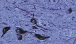 正常人：黑质神经元存在