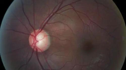 青光眼的克星来袭，助力患者远离视力的“窃贼”