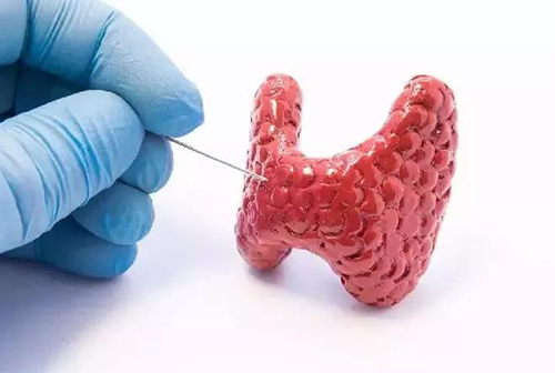 甲状腺疾。鬃聪俟δ芗跬撕图鬃聪俟δ芸航，自古以来就是反复被医学研究人员研究的疾病