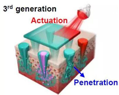第三代：通过微针介导的皮肤层破坏和微针伴随的各种功能增强药物转运.jpg
